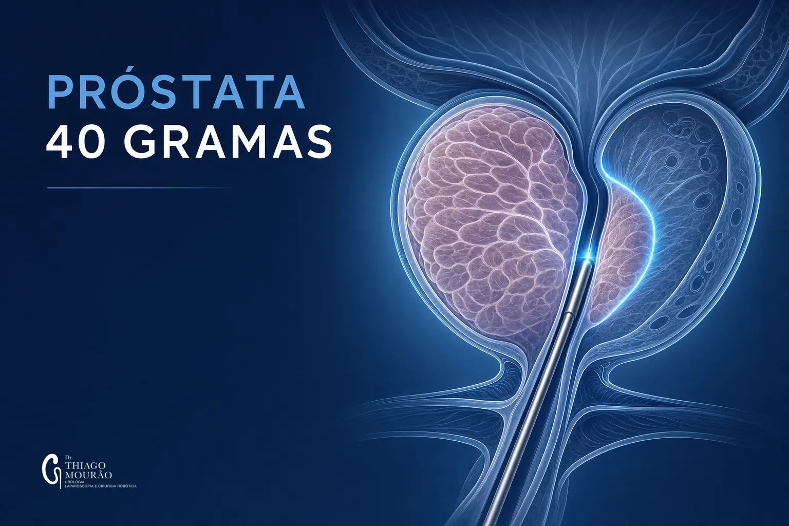 Ilustração médica sobre Próstata de 40 gramas: qual o tratamento, remédio ou cirurgia? — Dr. Thiago Mourão, urologista em São Paulo